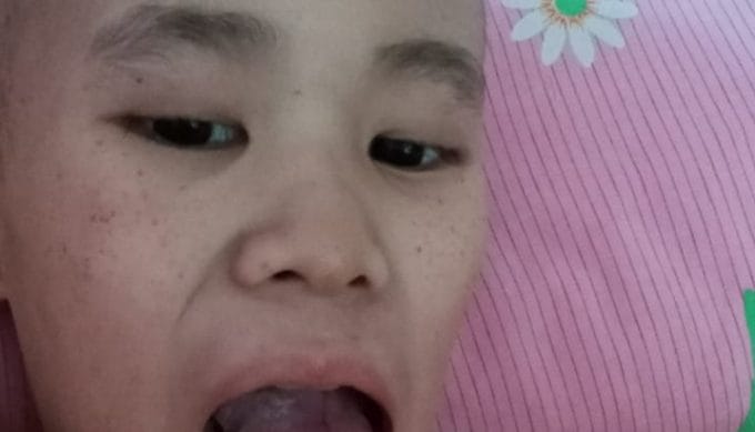 Mengidap Tumor Ginjal Stadium Empat, Adrian Butuh Uluran Tangan.